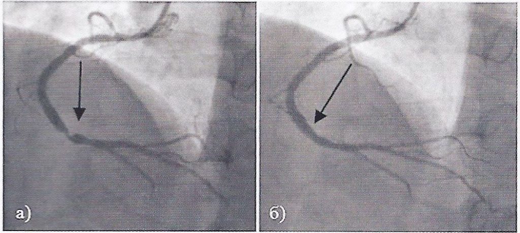 Коронарография сердца через руку